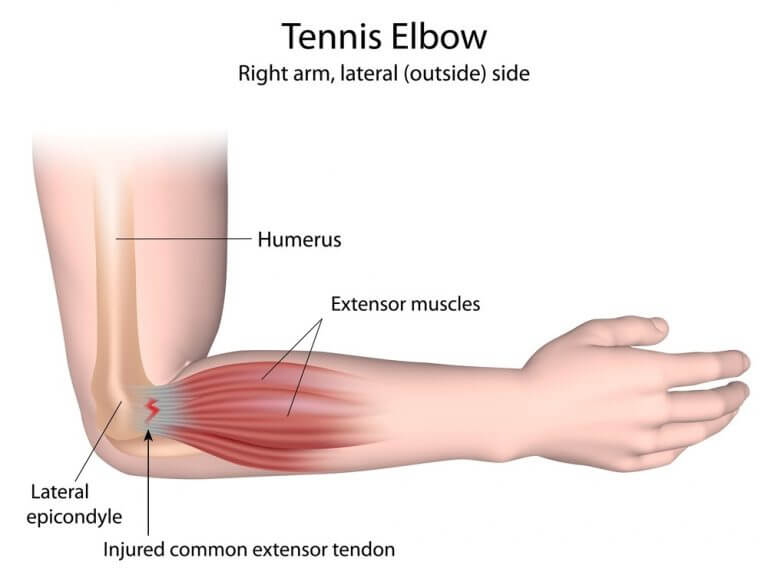 How Physio Can Provide Ulnar Nerve Pain Relief