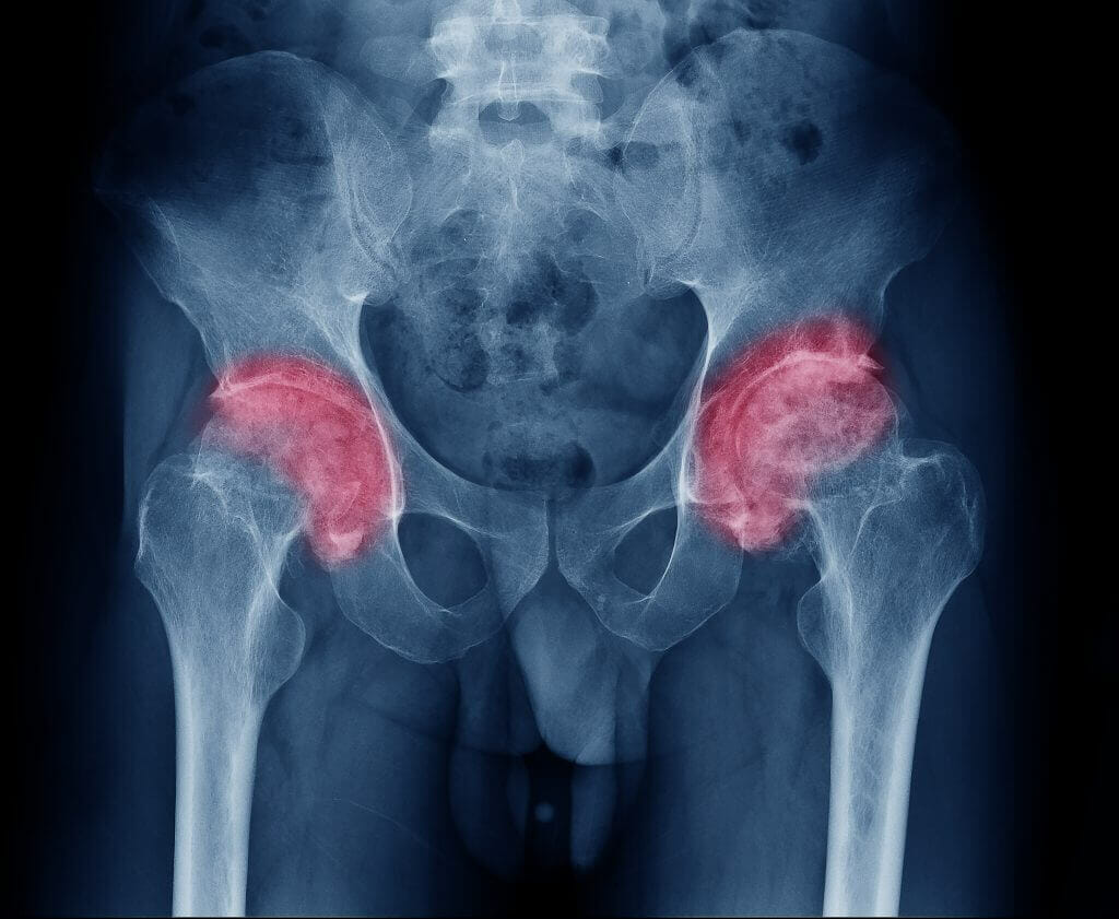 Hip Pain at Night: Causes, Treatment, Exercises