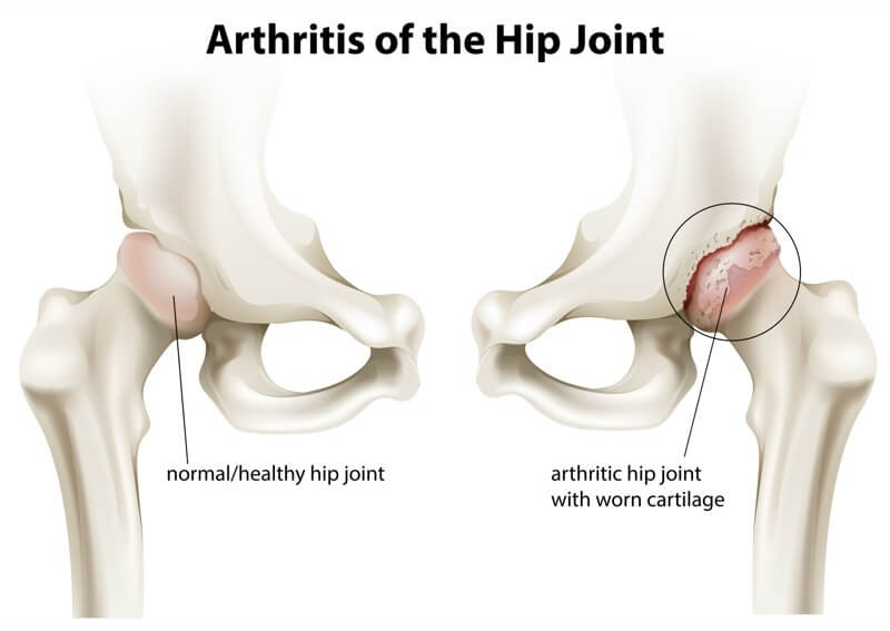 How To Sleep With Hip Pain