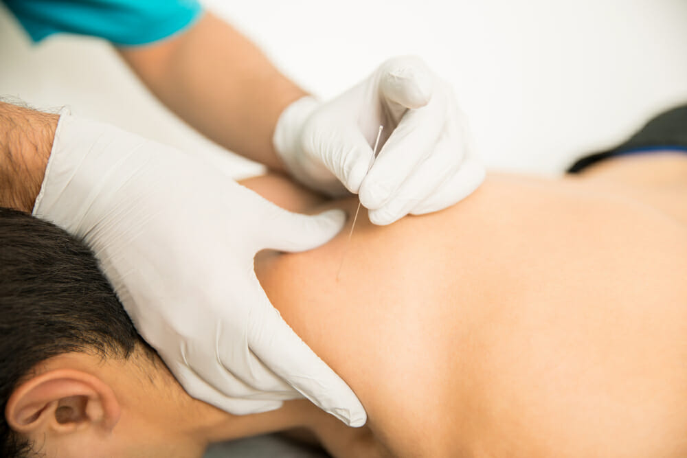 Dry needling treatment for nerve pain