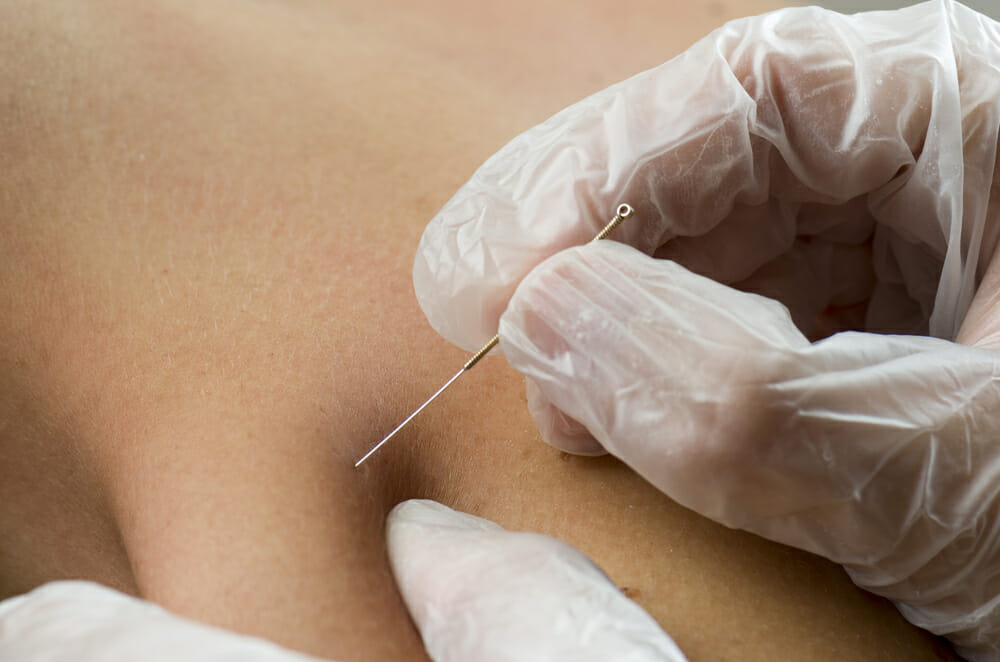 Dry needling for jaw pain